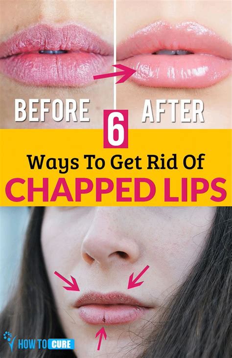 6 Natural Remedies To Get Rid Chapped Lips Howtocure Turns Out