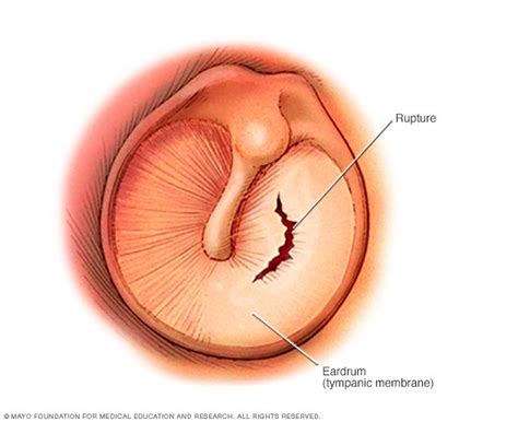 Ruptured eardrum (perforated eardrum) Disease Reference Guide - Drugs.com