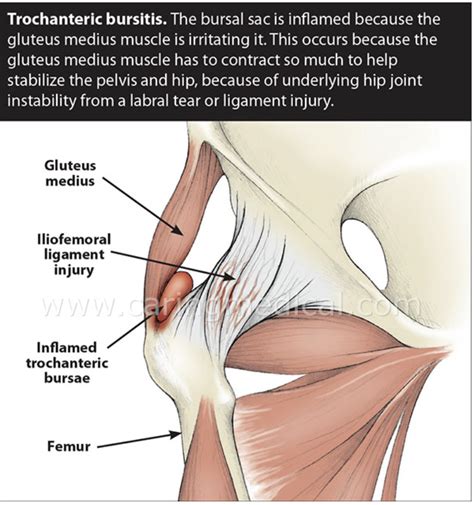 Tratamientos De La Bursitis Proloterapia Intensiva