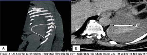 Figure From Syringo Pleural Shunt A Rare Cause Of Recurrent Pleural