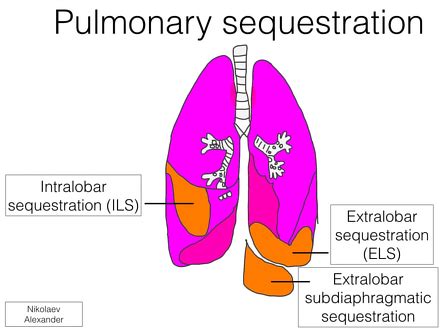 Pulmonary sequestration | Radiology Reference Article | Radiopaedia.org