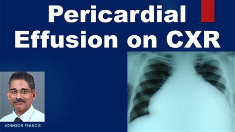 Pericardial Effusion On Cxr Youtube