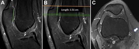 Vastus Medialis Oblique Mri