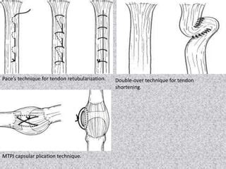 TENDINOPATHY AND TENDON REPAIR..pptx