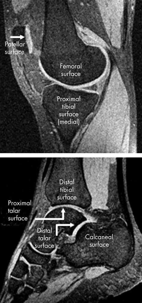 Correlation And Sex Differences Between Ankle And Knee Cartilage Morphology Determined By