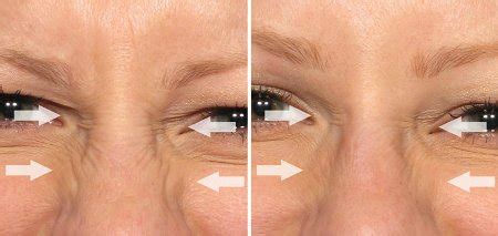 Nose Wrinkles | Bunny Lines - Treatment at Award Winning Karen Lockett ...