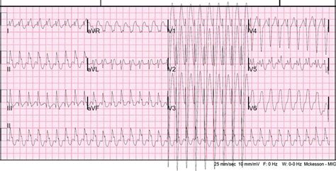 Wolff Parkinson White Syndrome