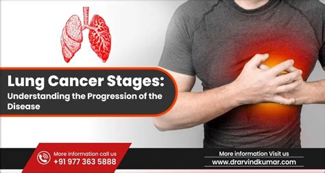 Decoding Lung Cancer Stages: A Comprehensive Insight