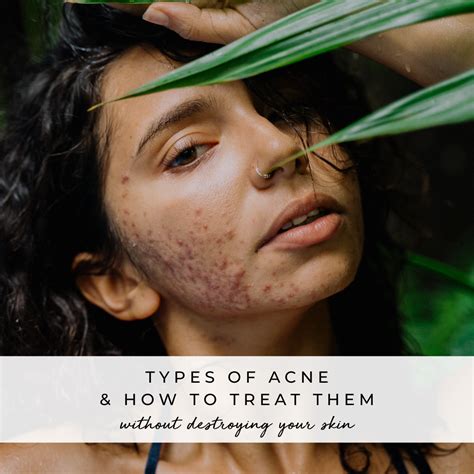 A Guide To The Different Types Of Acne And How To Treat Them Mood