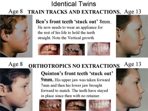 Evidence John Mew Orthotropics