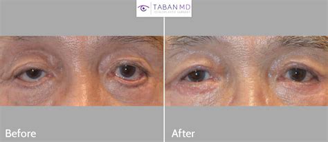 Ectropion After Lower Blepharoplasty