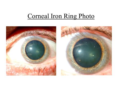 Cornea Iron Line On