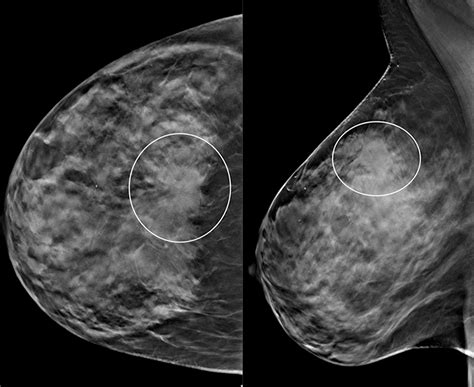 Five Consecutive Years Of Screening With Digital Breast Tomosynthesis