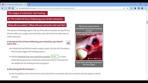 Tooth Extraction Healing Timeline Youtube