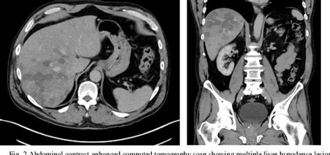 Figure From Multifocal Nodular Hepatic Steatosis A Rare Benign