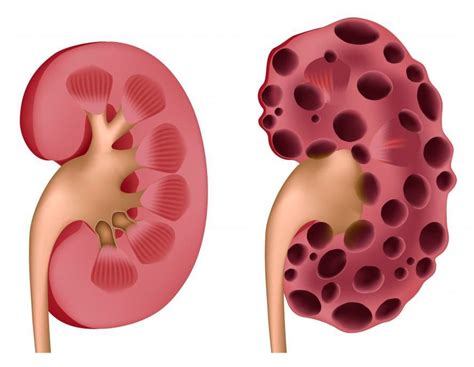 Most Common Causes of Chronic Kidney Disease - Healthy B Daily