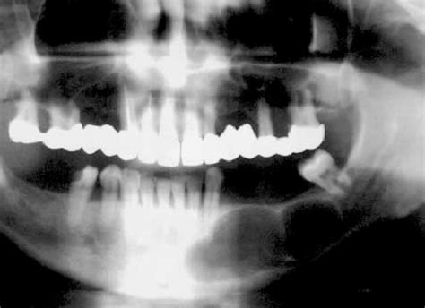 Calcifying odontogenic cyst-case 1. Orthopantomogram shows bilocular ...