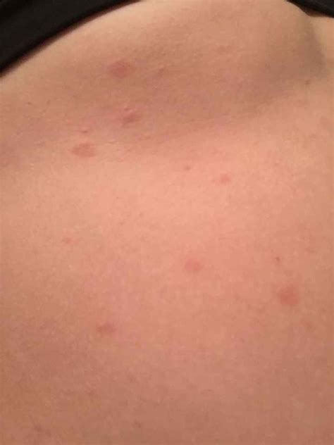 Stress Rash On Neck