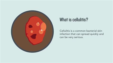 Cellulitis Causes Symptoms Diagnosis And Treatment Merck Manual Consumer Version Quick