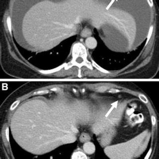 A Axial Contrast Material Enhanced Ct Scan In A Patient With Stage Iii