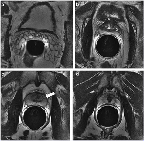 Normal Anatomy Of The Prostate Axial T2 Weighted Images Through The