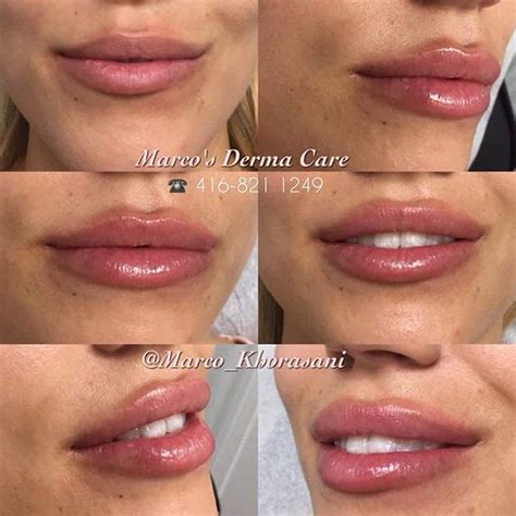 Pin On Lips Augmentation