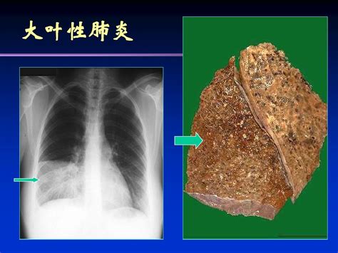 肺部感染性疾病pptword文档在线阅读与下载无忧文档