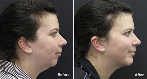 Chin Implants Photos | Philadelphia, PA | Patient 838