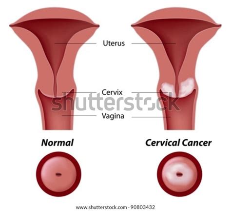 Carcinoma Cervix Over 151 Royalty Free Licensable Stock Vectors