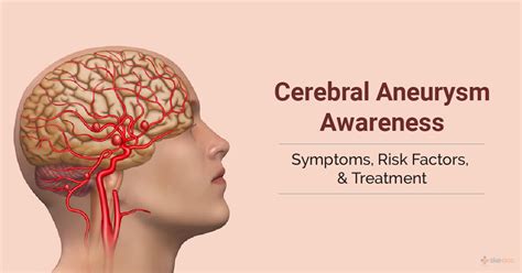 Cerebral Aneurysm Symptoms Causes Diagnosis And Treatment