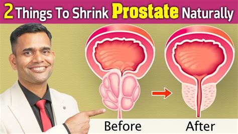 2 Things To Shrink Prostate Naturally Shrink Your Enlarged Prostate