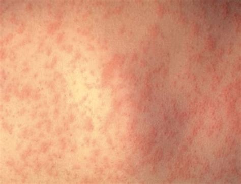 HIV Skin Rash - Images, Causes, Symptoms, Treatment - HubPages