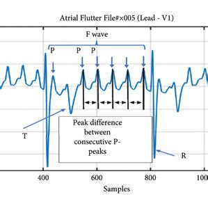 Hypothetical Propagation Of Depolarization Wavefront Inside The Atrium