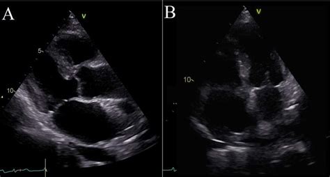 A B Transthoracic Echocardiographic D Images Parasternal Long Axis