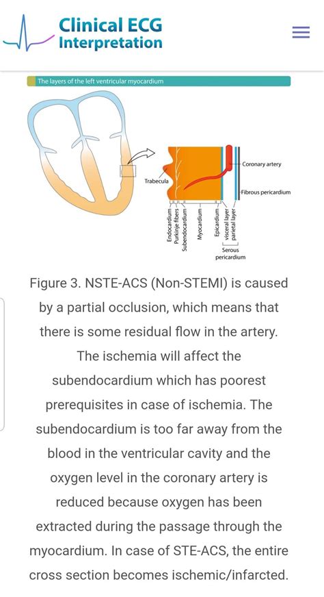 Non Stemi Ecg Interpretation St Elevation Unstable Angina