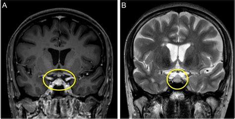 T1 Weighted A And T2 Weighted B Images Of The MRI Performed During