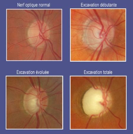 Altération du nerf optique et glaucome des photographies pour