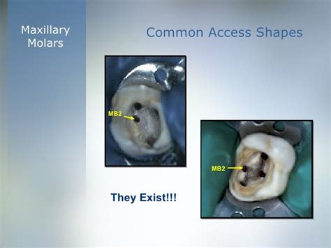 Coronal Cavity Preparation ‘access