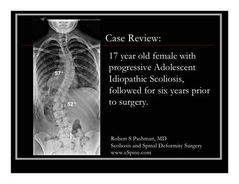 Case Review 19 Adolescent Idiopathic Scoliosis