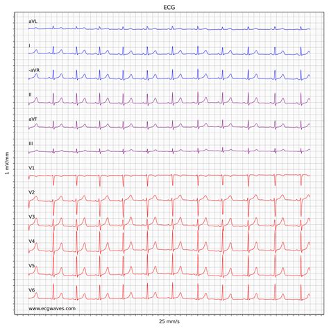 ECG Test – Quiz 5 - Mixed Conditions – The Cardiovascular