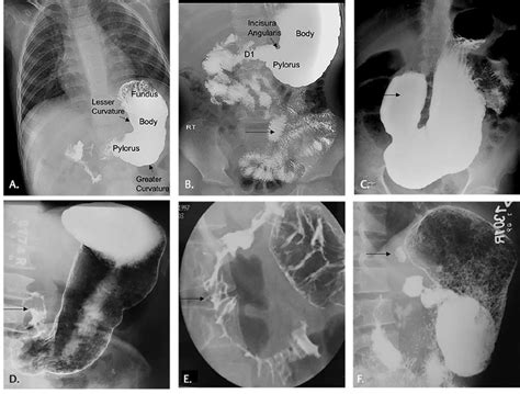 Barium meal showing fluoroscopic appearance of stomach and duodenum ...