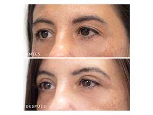 Blefaroplastia antes y después precio y resultados Clínica Opción Médica