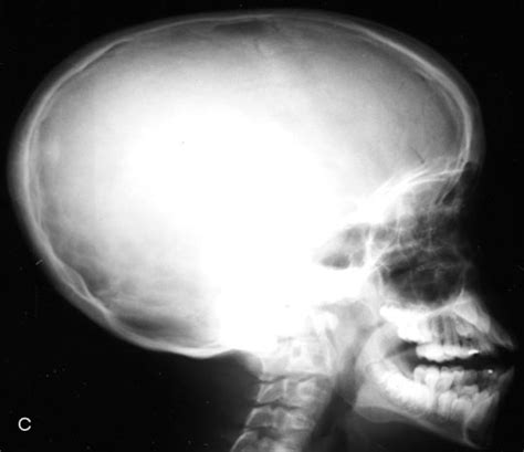 Achondroplasia X Ray Vs Normal