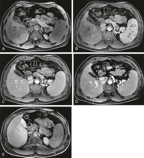 Liver Normal Anatomy And Examination Techniques Radiology Key