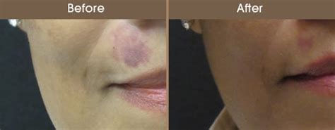 Hemangioma Treatment New York | Laser Therapy and Treatments