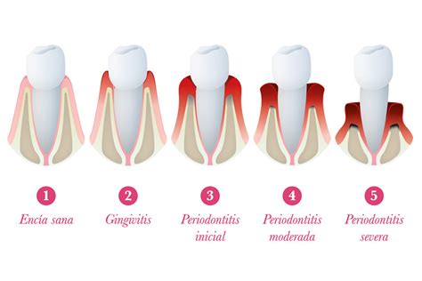 Periodoncia Aluche Clínica Dental Doctores Rodrigo