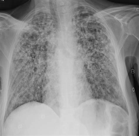 Anteroposterior Chest Radiograph Taken At Time Of Admission This Image