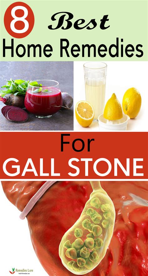 8 Best Home Remedies For Gall Stone - Remedies Lore