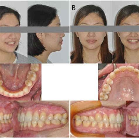 Extraoral And Intraoral Photographs Of A Posttreatment Phase B Download Scientific Diagram