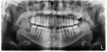 Keratocystic tumor of mandible | Radiology Case | Radiopaedia.org